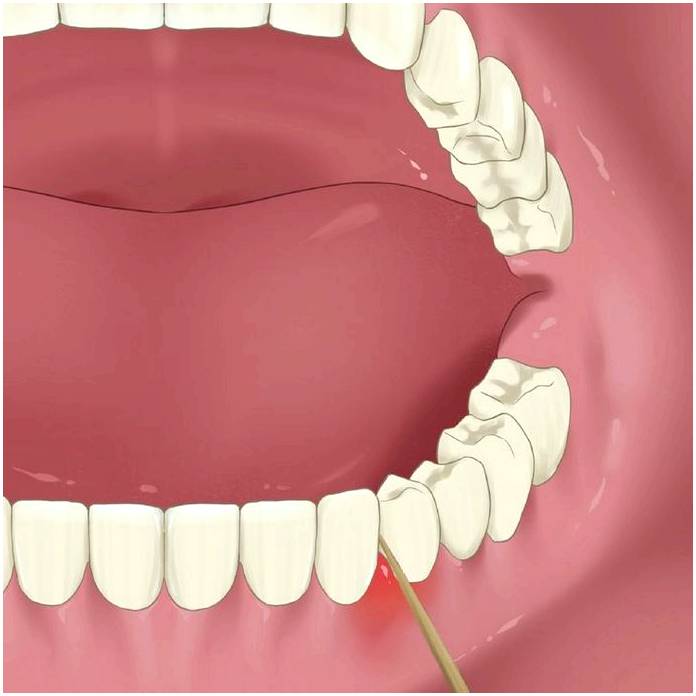 Каковы преимущества и недостатки использования зубочисток, зубной нити и ирригатора