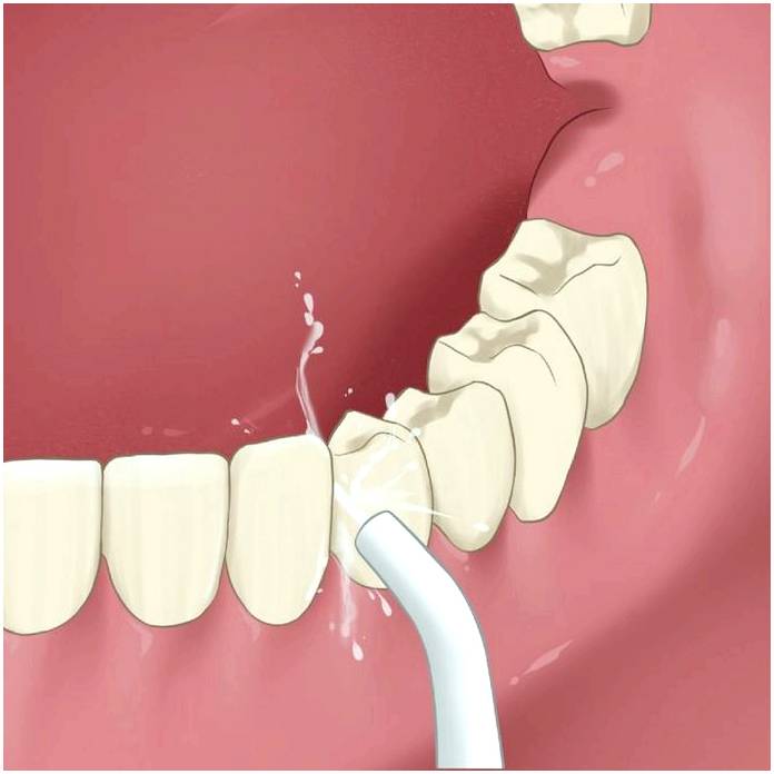 Каковы преимущества и недостатки использования зубочисток, зубной нити и ирригатора