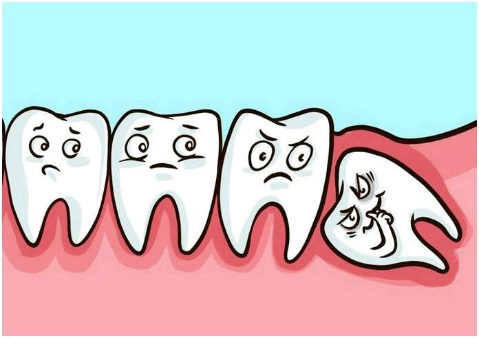 Какое влияние оказывают зубы мудрости на организм?